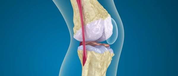 Остеопороз коленного сустава – симптомы и лечение народными рецептами